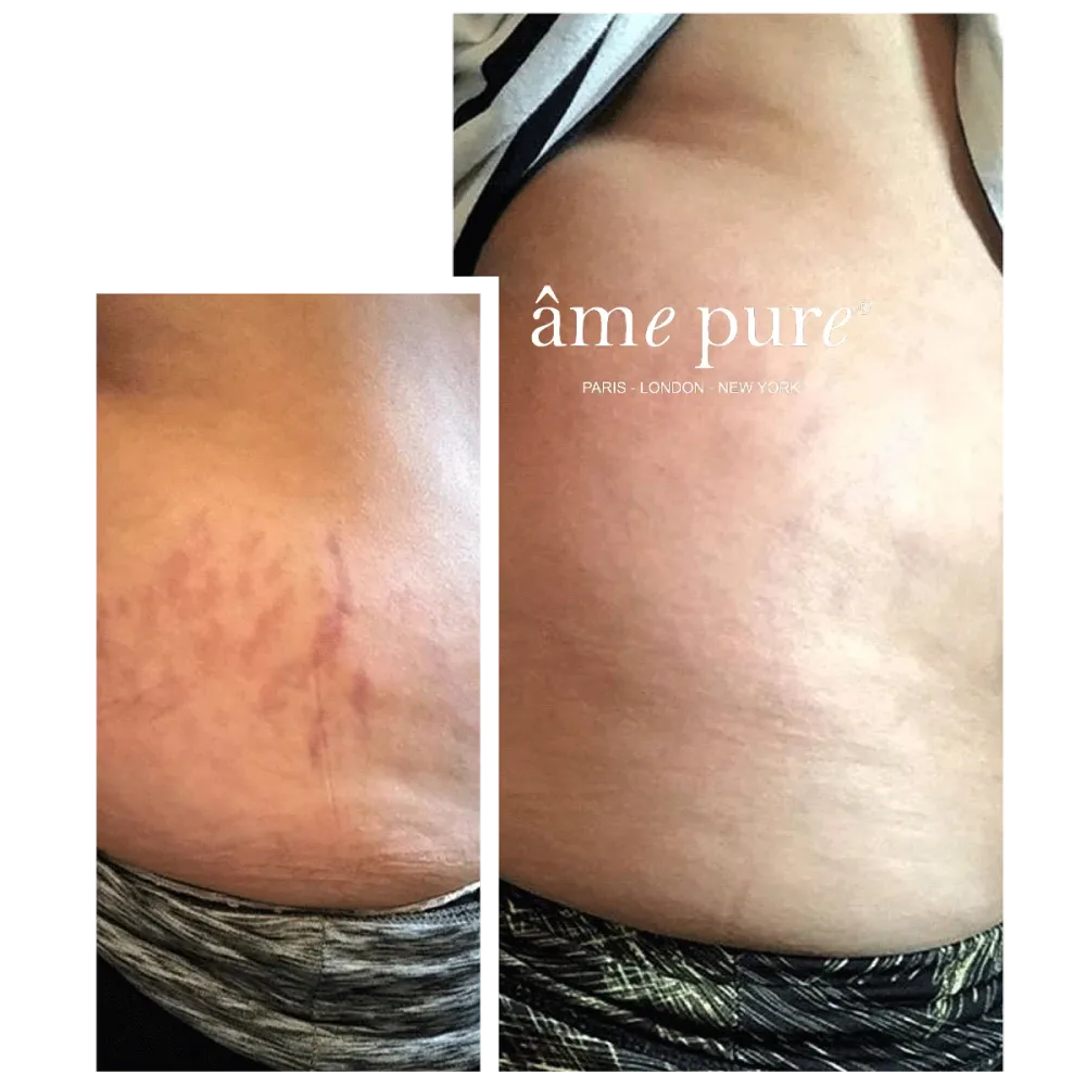 Body Basic | Stretch Marks âme pure