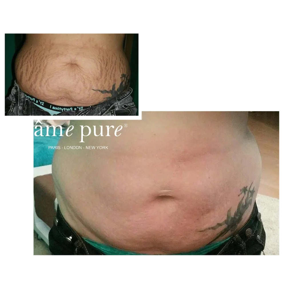 Body Basic | Stretch Marks âme pure