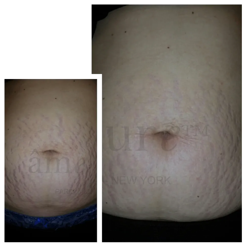 Body Basic | Stretch Marks âme pure