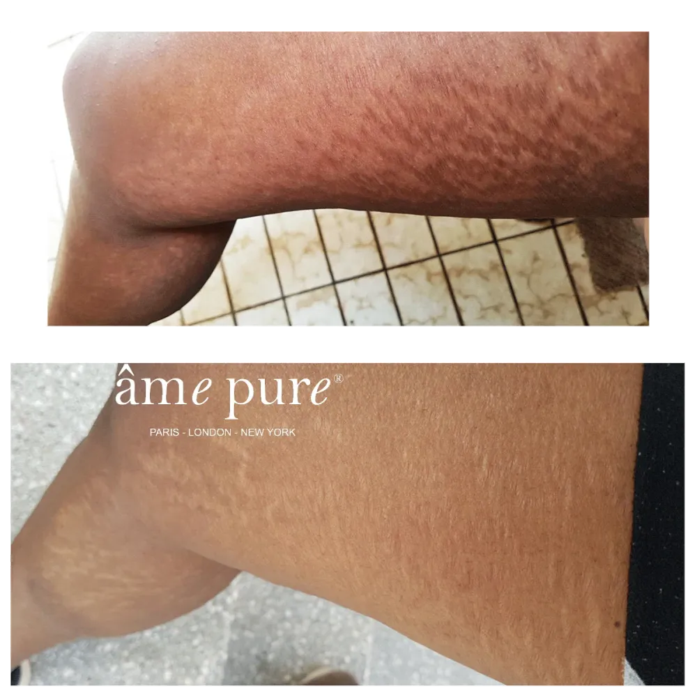 Body Basic | Stretch Marks âme pure