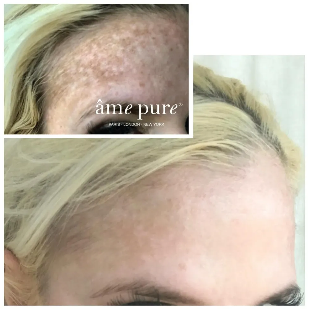 WrinklEraser™ BASIC âme pure