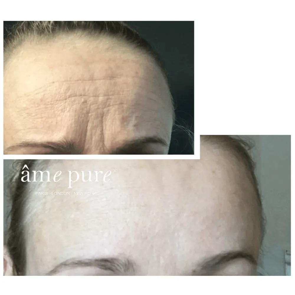 WrinklEraser™ BASIC âme pure