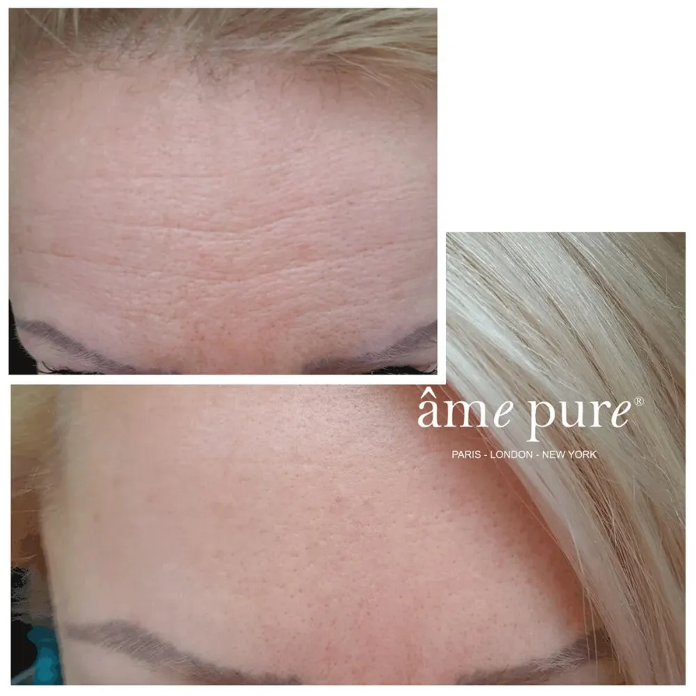 WrinklEraser™ BASIC âme pure