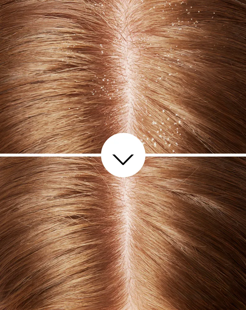 Hilsettä ehkäisevä hiusshampoo, jossa on olamiinipyroktonia, jolla on kosteuttava vaikutus Nutridome